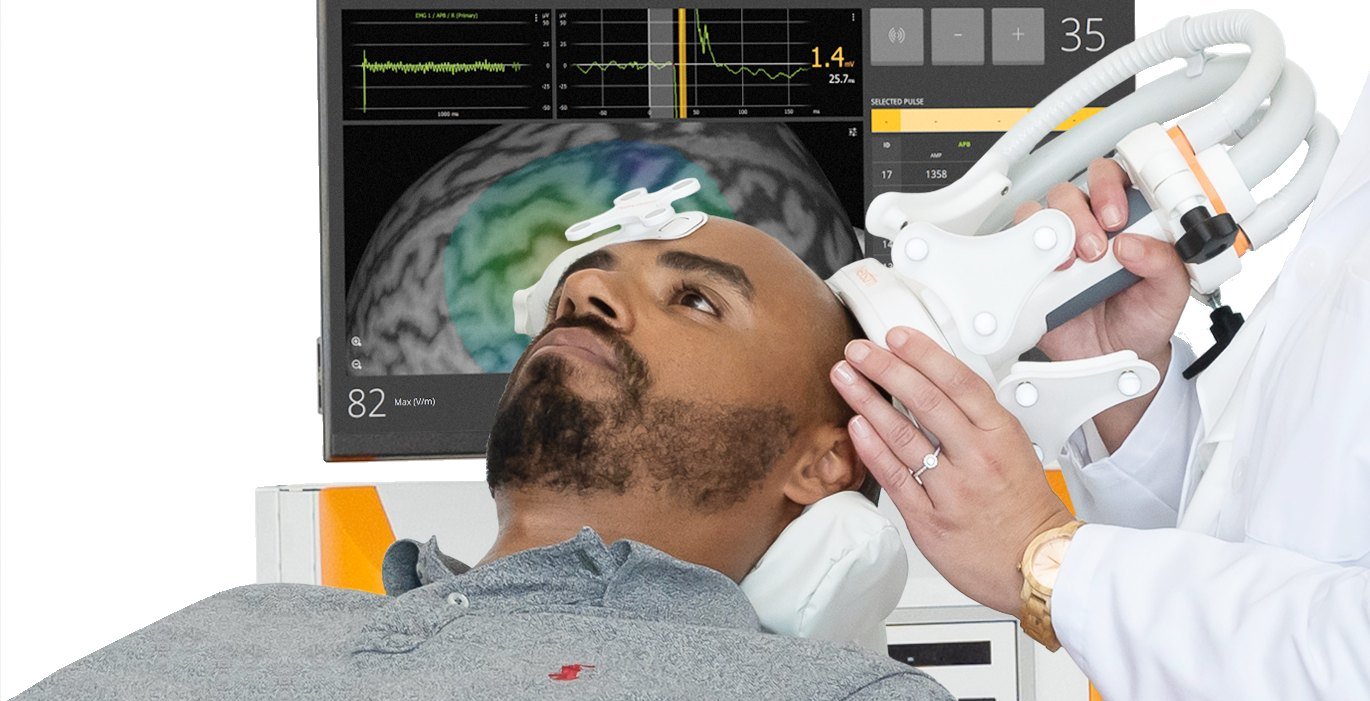 A clinician positions the navigated TMS treatment coil against a patient's head while the Nexstim system screen displays that patient's MRI with the stimulation target highlighted.